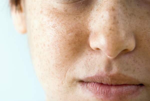 #ศูนย์ผิวหนัง #โรงพยาบาลศิริราช ปิยมหาราชการุณย์ #picosecond laser คือ #เลเซอร์รักษากระ ฝ้า #เลเซอร์ รักษาจุดด่างดํา #เลเซอร์ลบรอยสัก #เลเซอร์ลดริ้วรอย #กระตุ้นการสร้างคอลลาเจน #เลเซอร์หน้า เจ็บไหม #รักษากระแดดที่หน้า