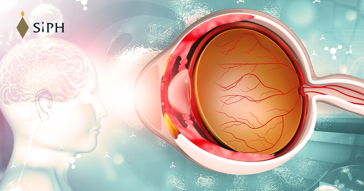 โรคเส้นประสาทตาอักเสบ (Optic Neuritis)