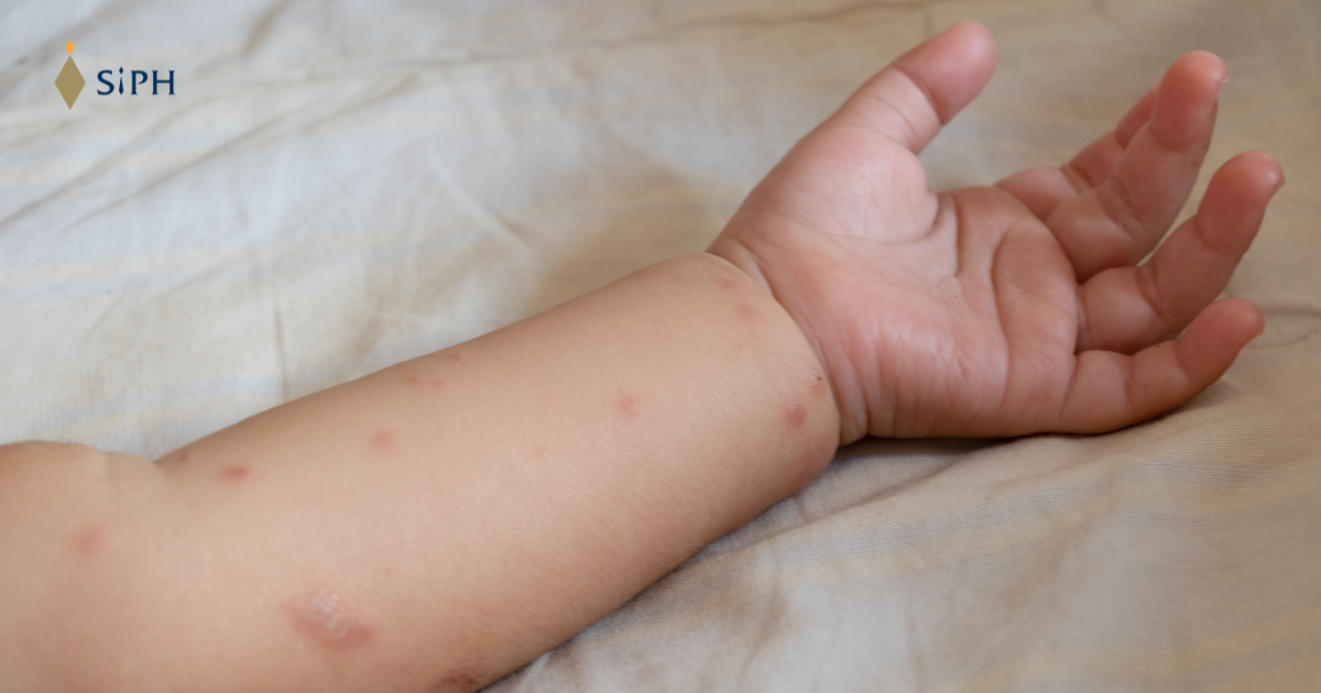 โรคอีสุกอีใสในเด็ก