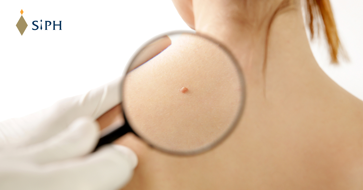 ติ่งเนื้อ (Skin Tags) อันตรายไหม? สาเหตุ วิธีรักษา และการป้องกันที่ถูกต้อง