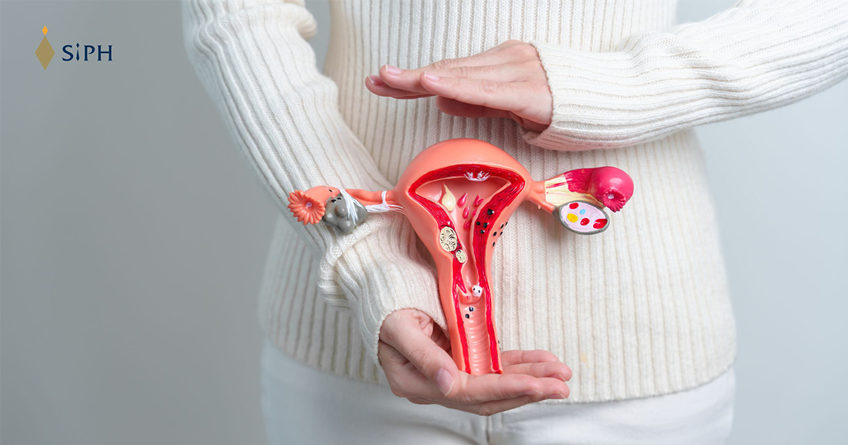 ซีสต์รังไข่ หรือปีกมดลูกบิดขั้ว