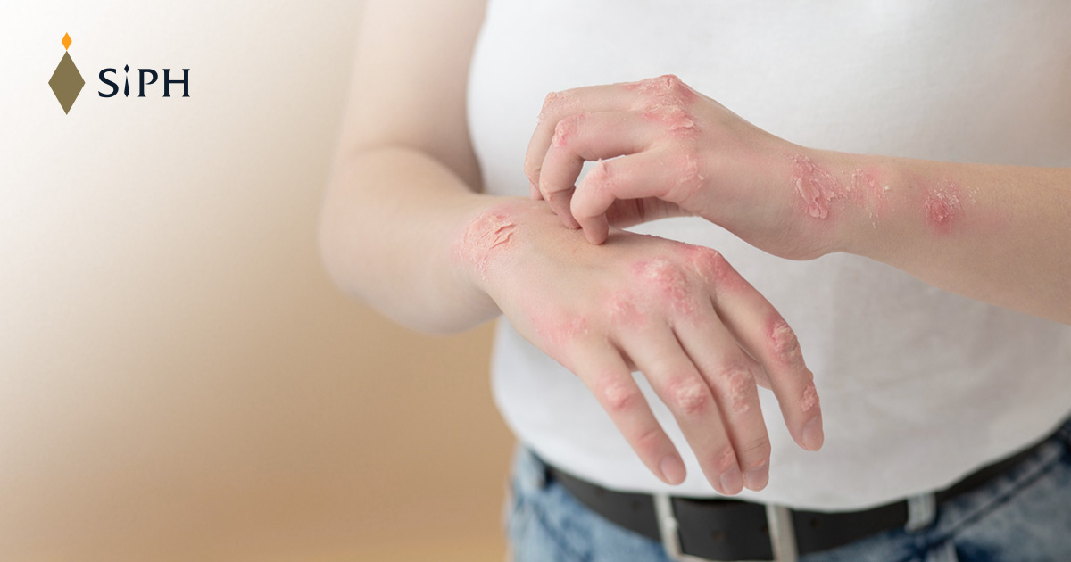 โรคผื่นภูมิแพ้ผิวหนัง (Atopic dermatitis)